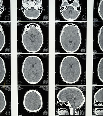 scan of brains