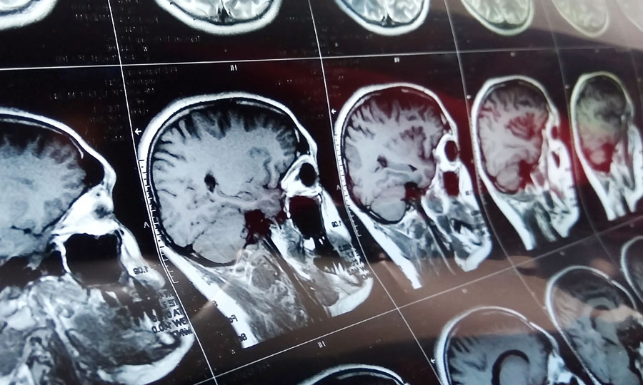 Neuro Rehab for Traumatized Brain